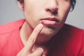 Inverno ... vuol dire Herpes??
